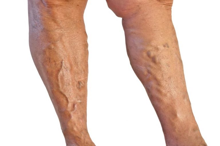 Schaumburg Spider Vein Treatment