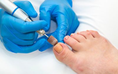 Expert Solutions to Prevent Reoccurrence and Alleviate Pain: Ingrown Toenail Treatment in Jacksonville, FL