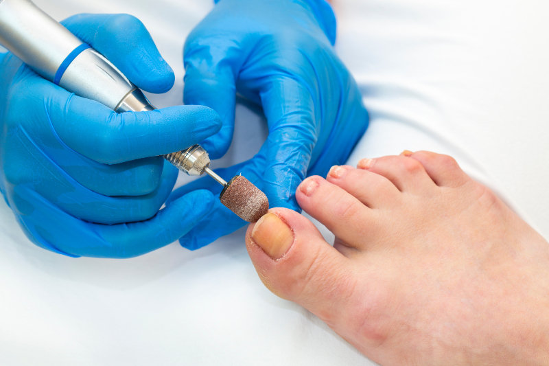 Expert Solutions to Prevent Reoccurrence and Alleviate Pain: Ingrown Toenail Treatment in Jacksonville, FL